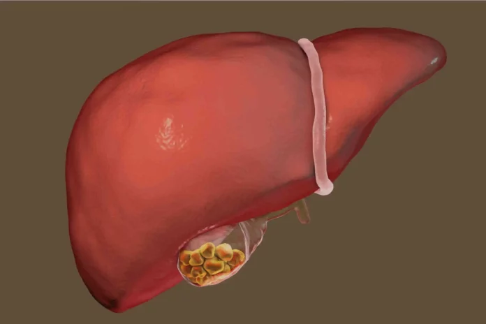 Gallbladder Disease